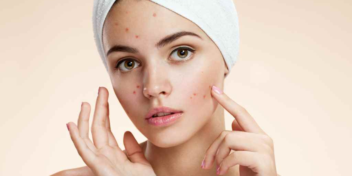 The Best Essential Oils For Pimples & Acne-Prone Skin