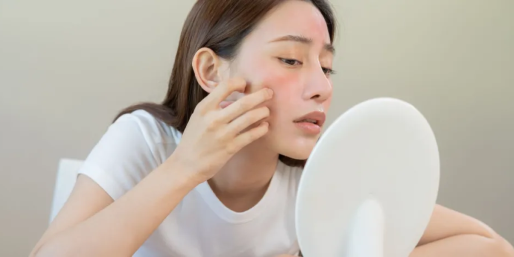 Best Essential Oils To Treat Acne-Prone Skin, Pimples & Scars Naturally